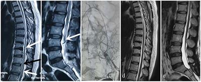 Spinal dural arteriovenous fistula: A rare but treatable disease that should not be missed by orthopedic surgeons